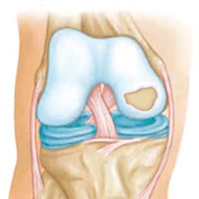 Cartilage repair surgery